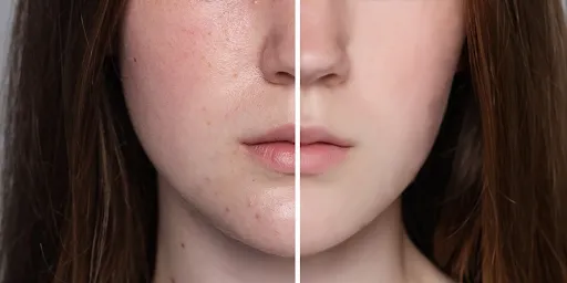 dry-skin-and-dehyrated-skin